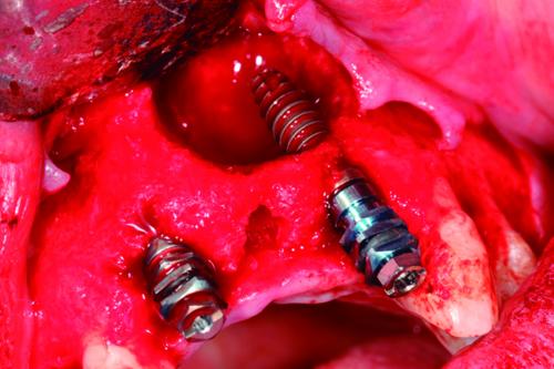 Tratamientos con implantes de conexión externa Universal
