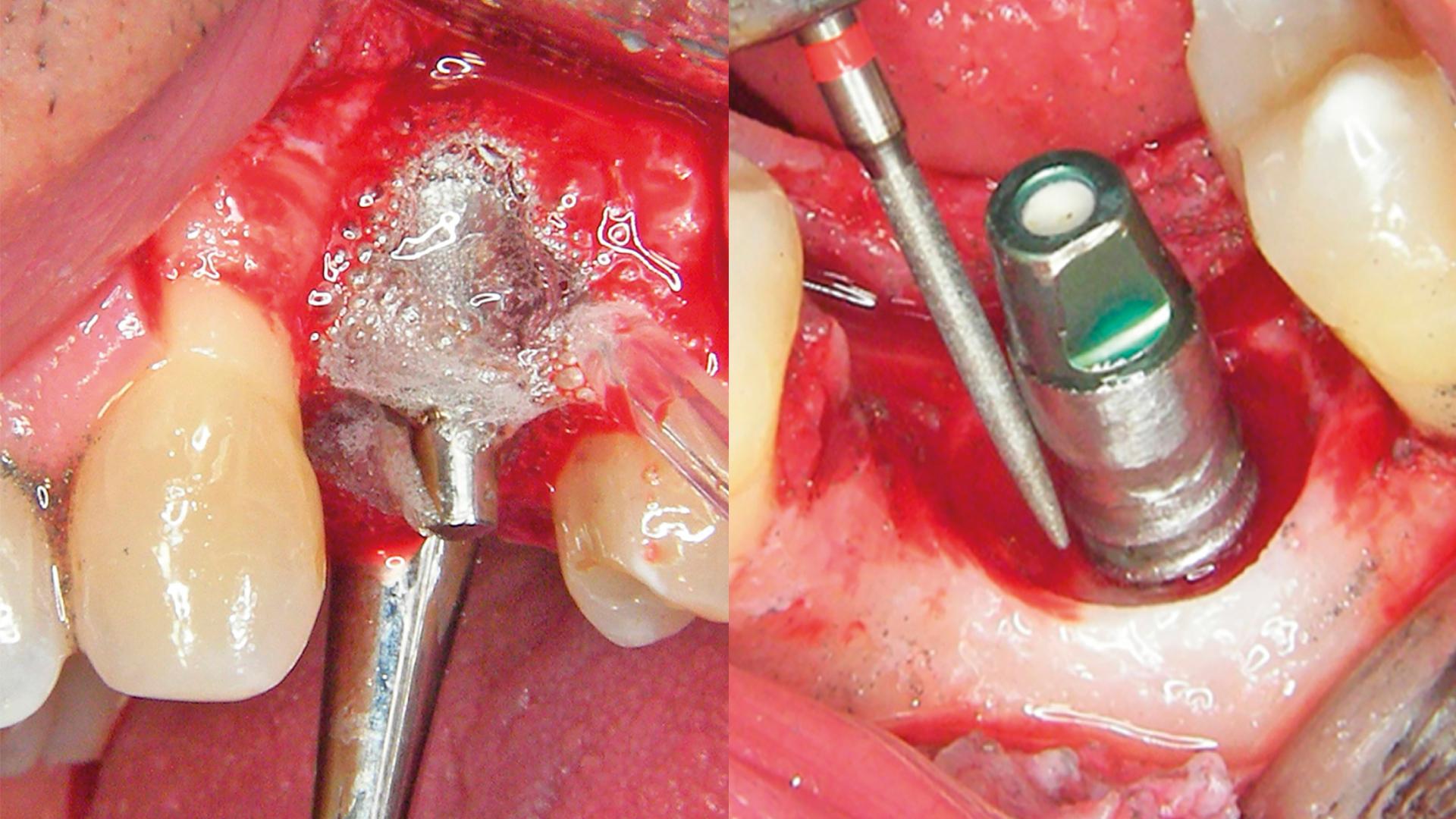 Periimplantitis